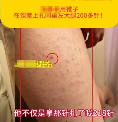 校園防欺凌報警器：“女生被同桌扎218針”，未達到校園霸凌標(biāo)準(zhǔn)？多方回應(yīng)